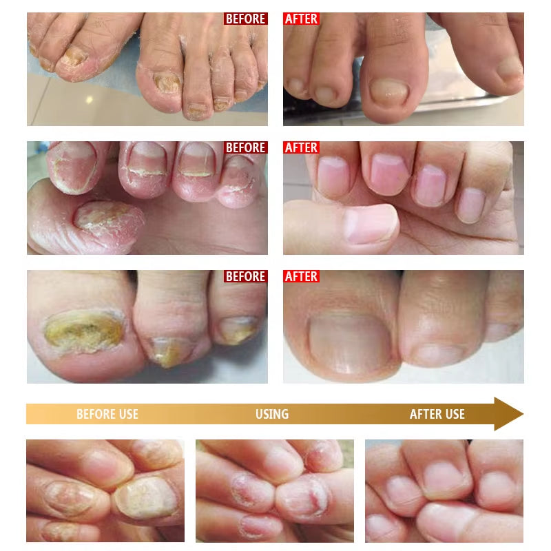 ARTISCARE Nail Care Essence Feet Care Nail Serum 20Ml